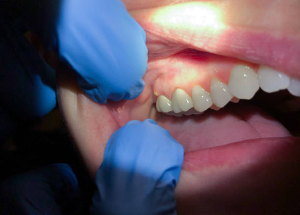 Best Emergency Treatment for Oral Infections in West Wood, UT